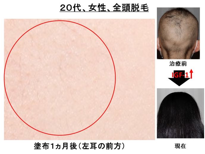 円形脱毛症　病院